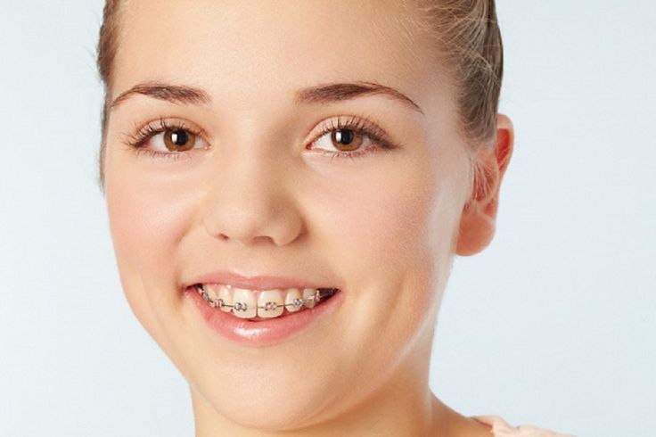 Niềng Răng Có Tiêm Filler Được Không? [Giải Đáp Từ Chuyên Gia]