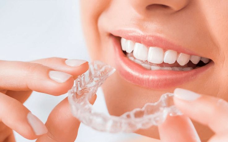 Bật Mí Cách Vệ Sinh Khay Niềng Trong Suốt Đơn Giản